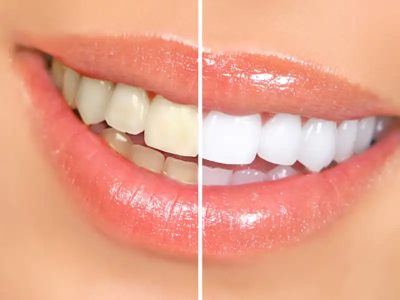 permanent teeth whitening in indore, dentist in indore, dental clinic indore