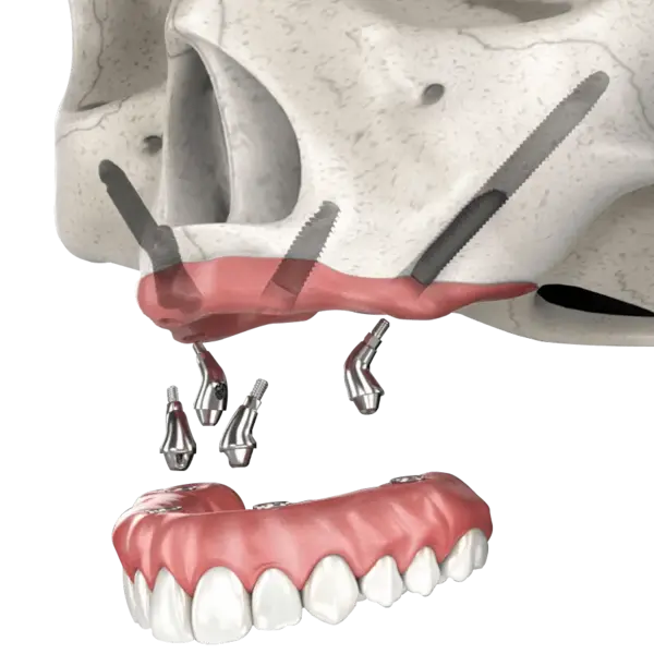dental Implants In Indore, Implant specialist in indore