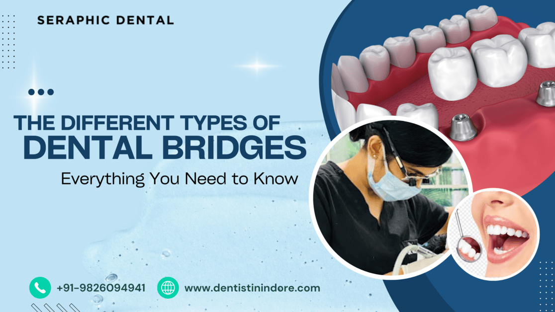 Types of dental bridges