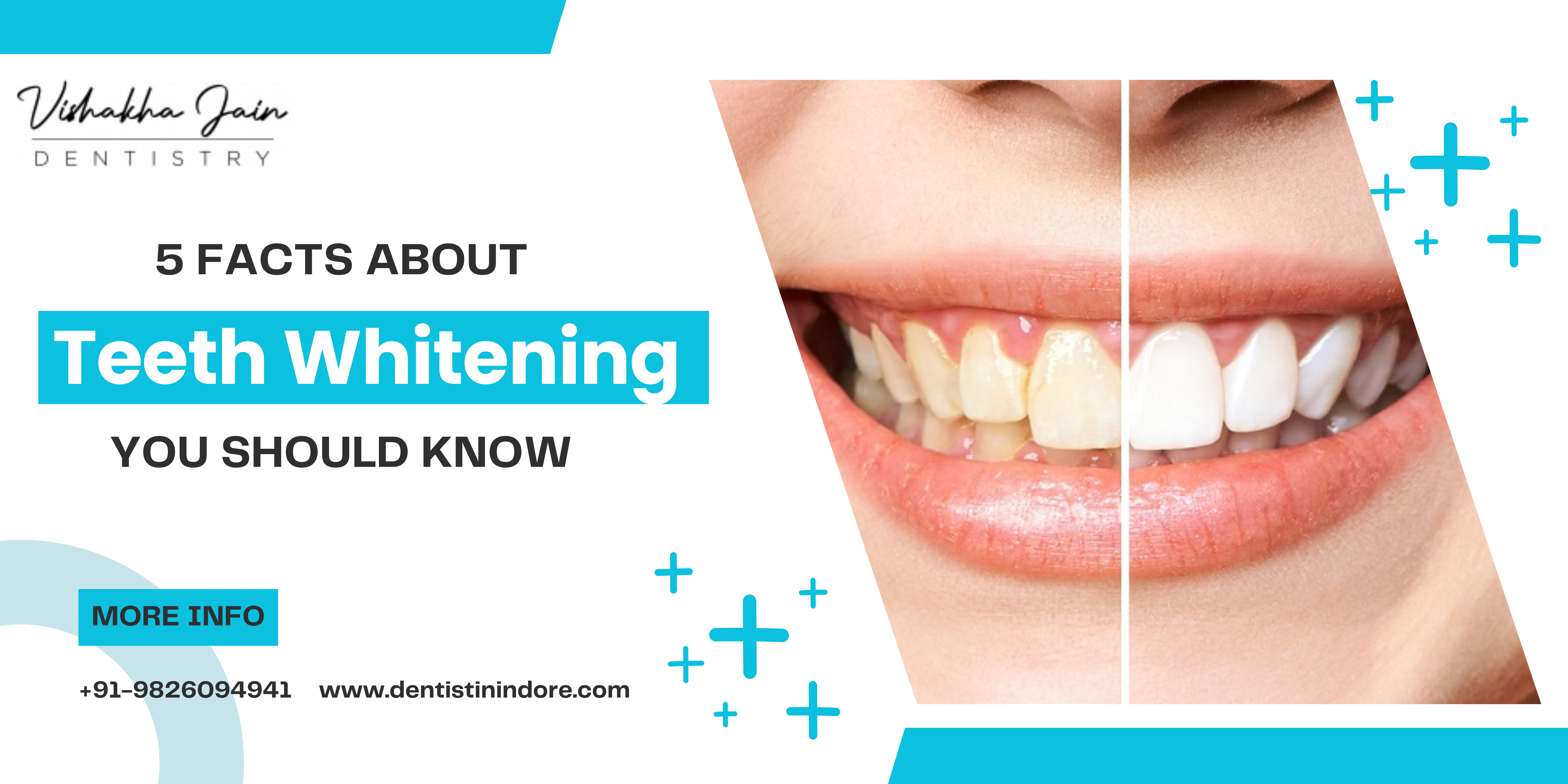 Teeth whitening in indore