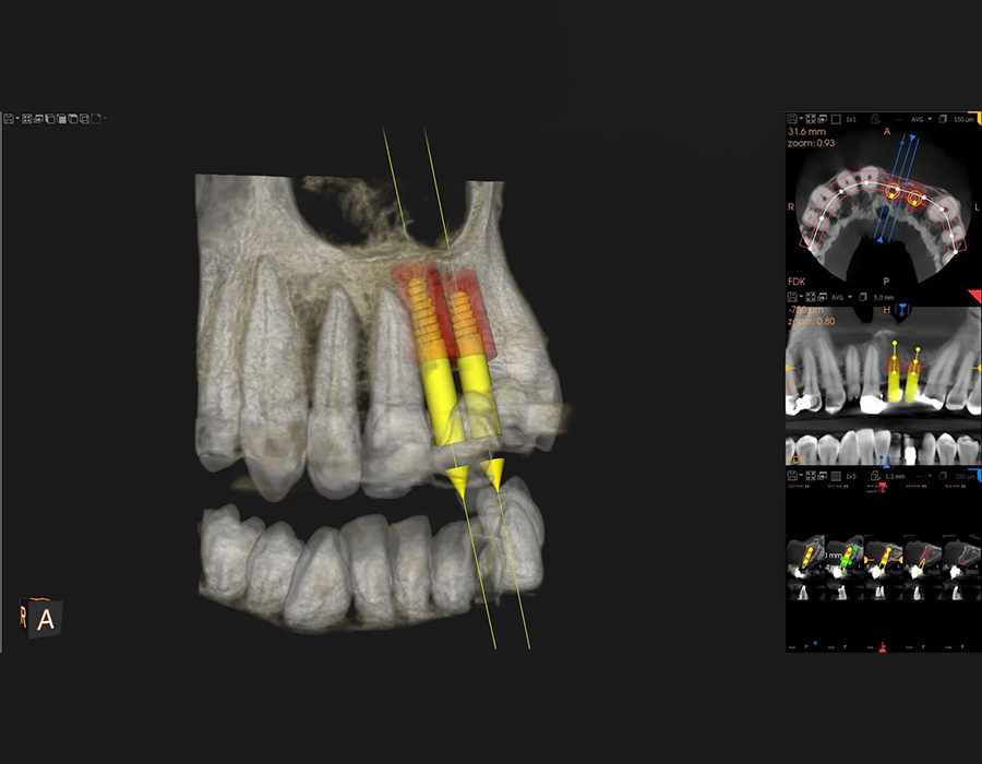 X-ray-dental-implant