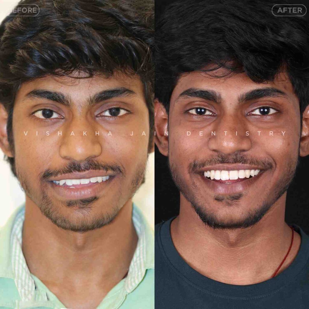 smile correction indore