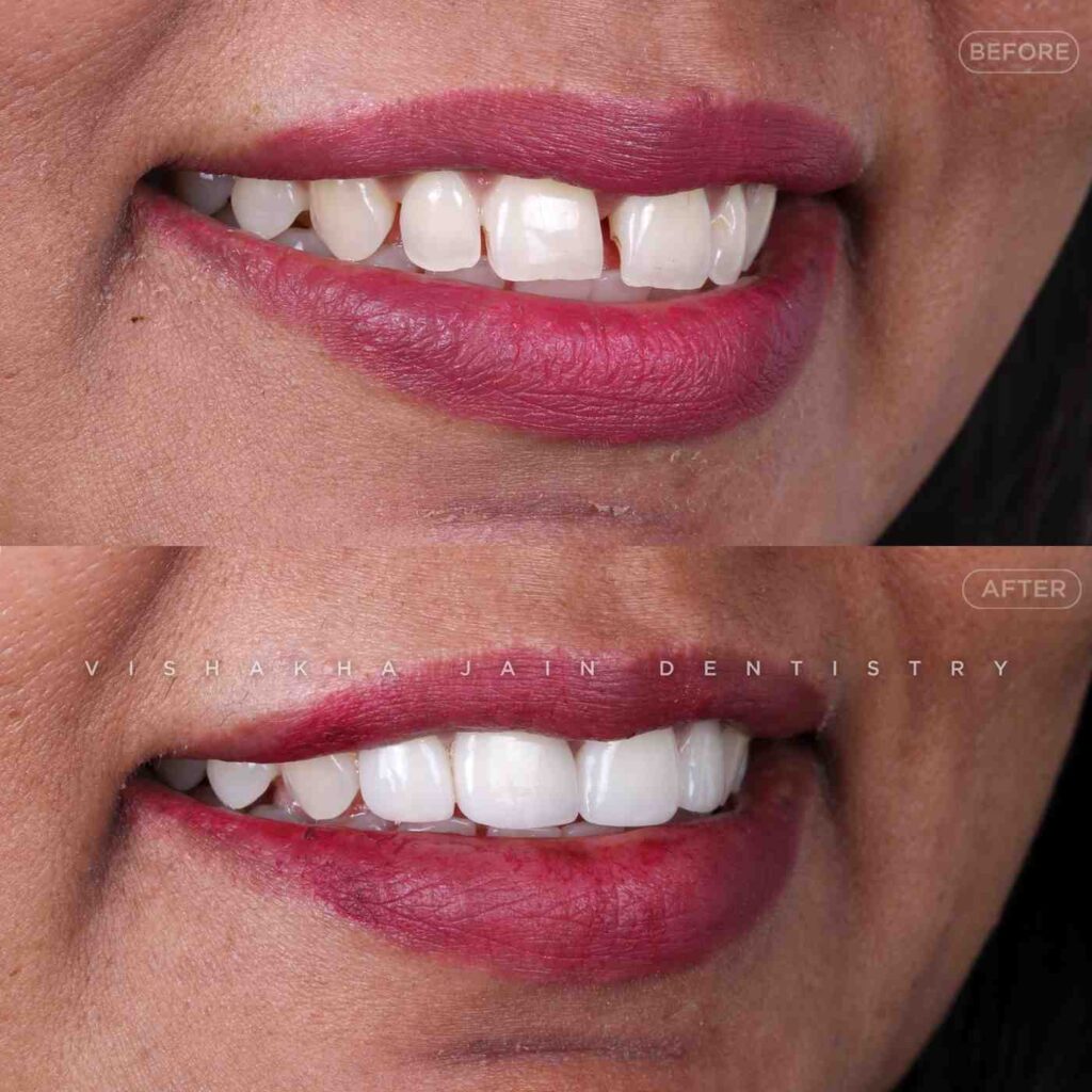 best cosmetic dental treatment in indore