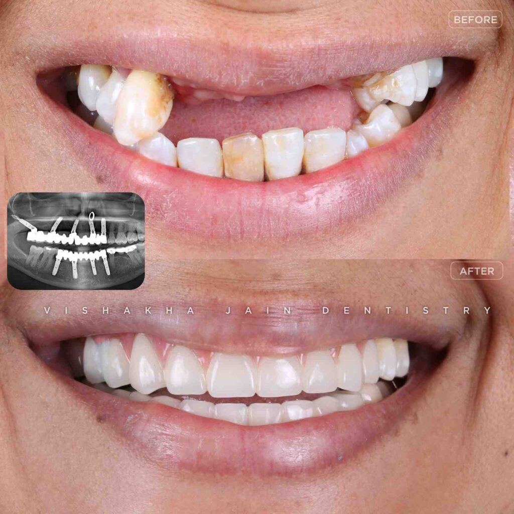 best dental implant treatment in indore