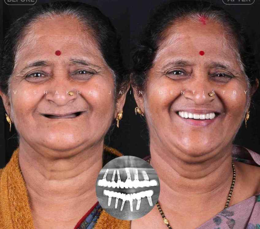 best dental implant treatment indore