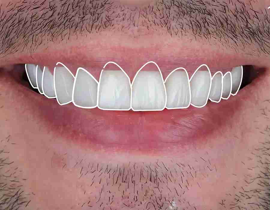 best-smile-design-in-veneer_11zon