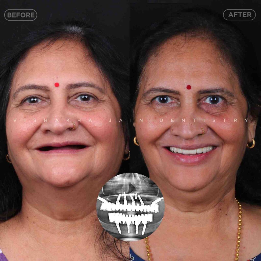 dental full mouth implant indore