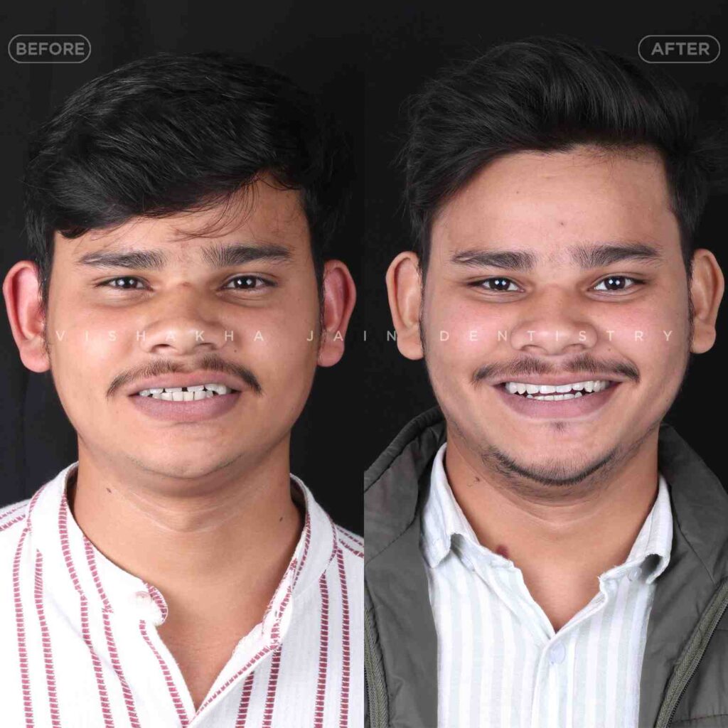 braces alternative indore