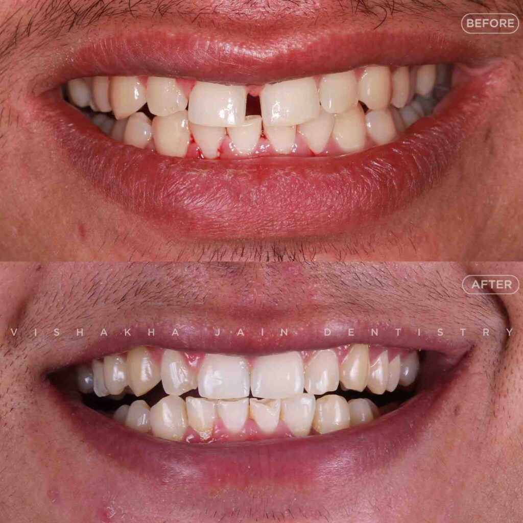 clear aligners indore