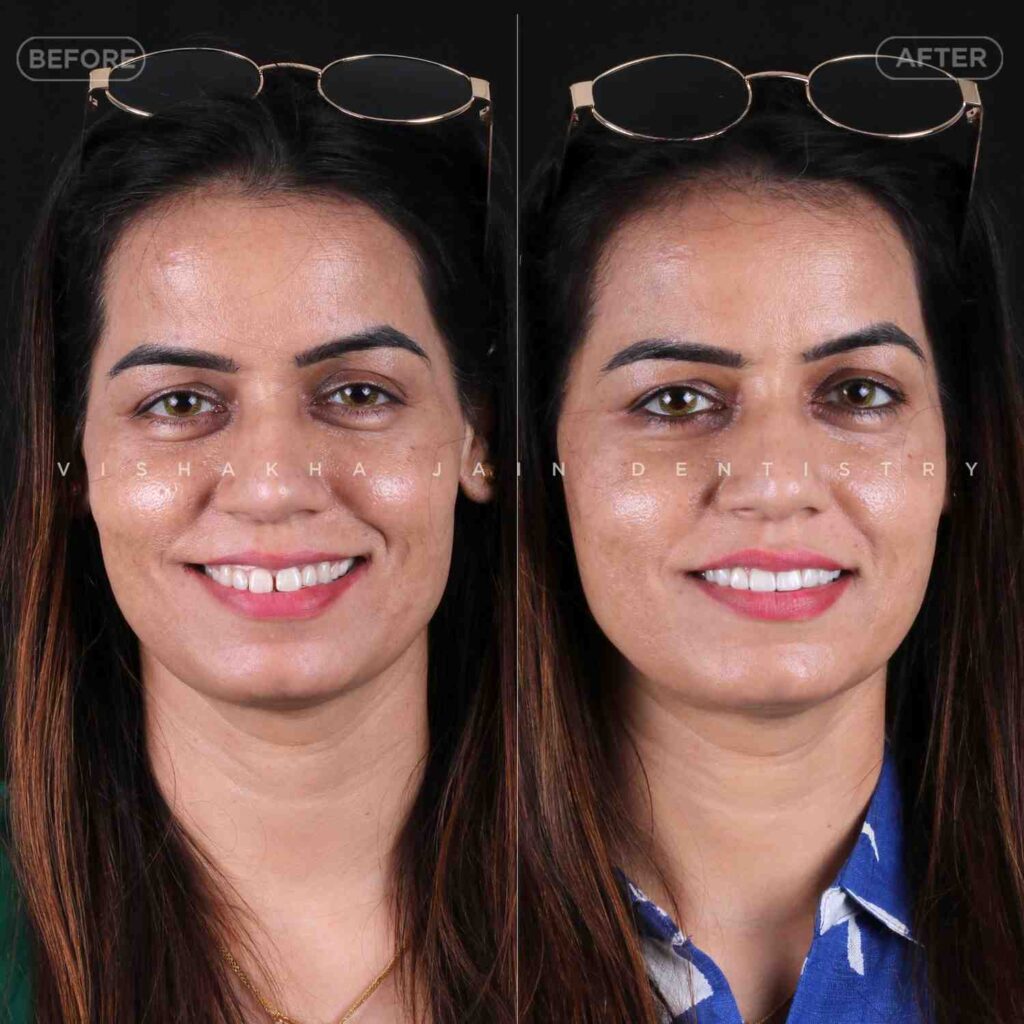 cosmetic dental treatment in indore