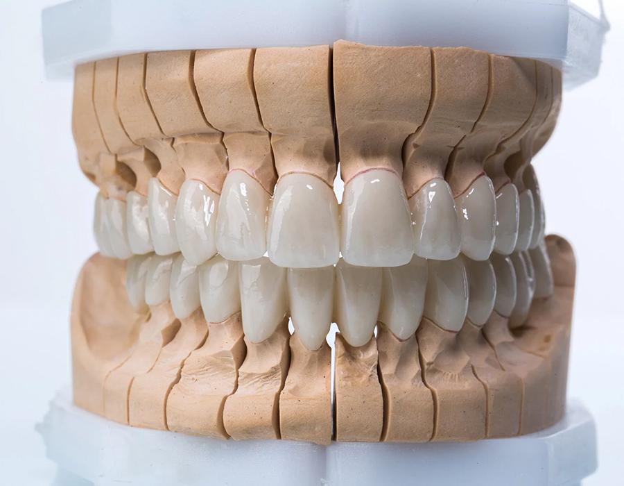 dental crowns in indore