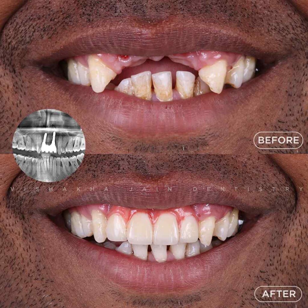 dental-implant-indore-treatment