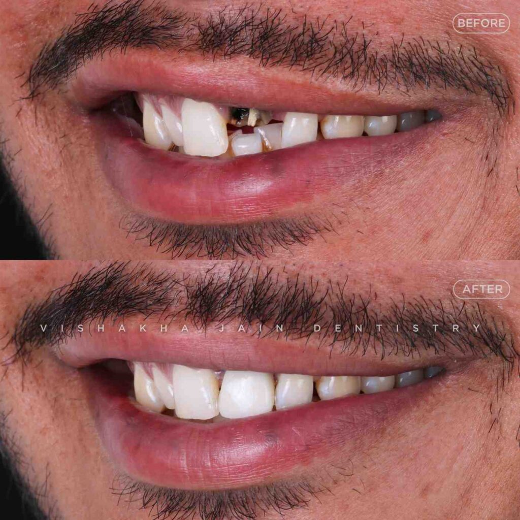 dental-implant-treatment-in-indore