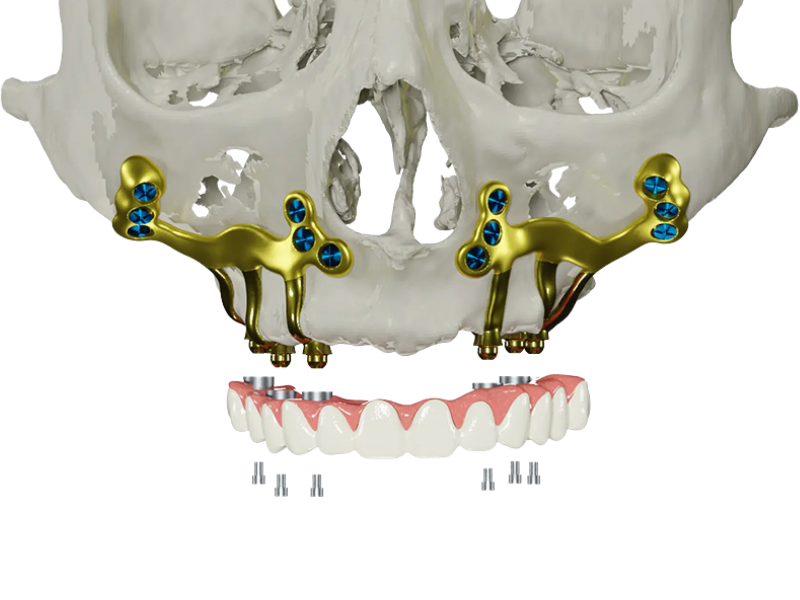 dental implant treatment indore