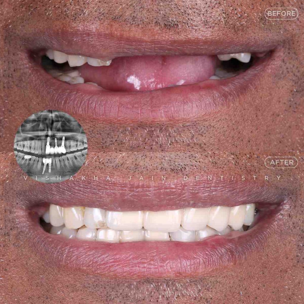 dental-treatment-indore