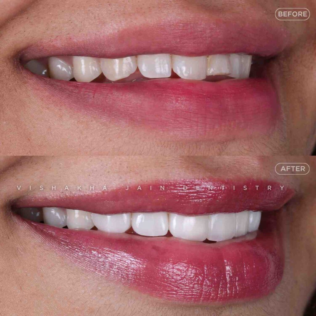 dental veneers indore