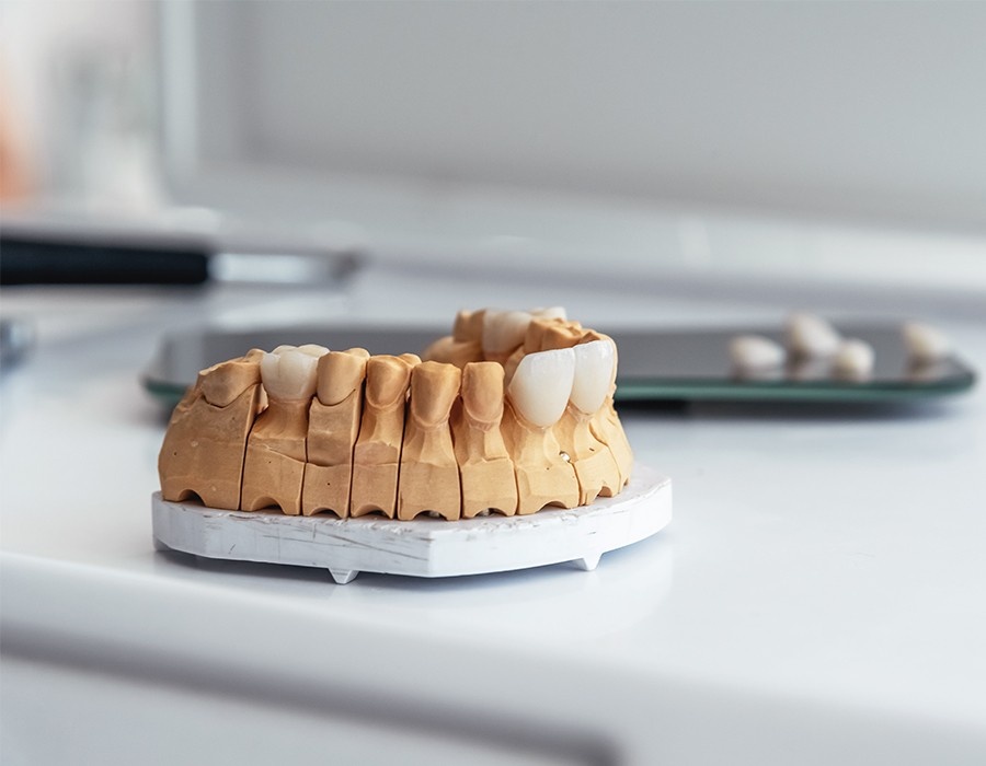 dental-venner-treatment-in-indore