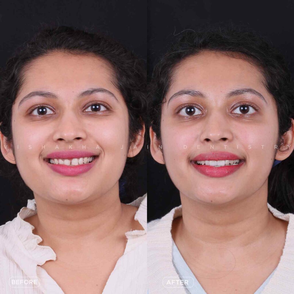 dental venner treatment in indore