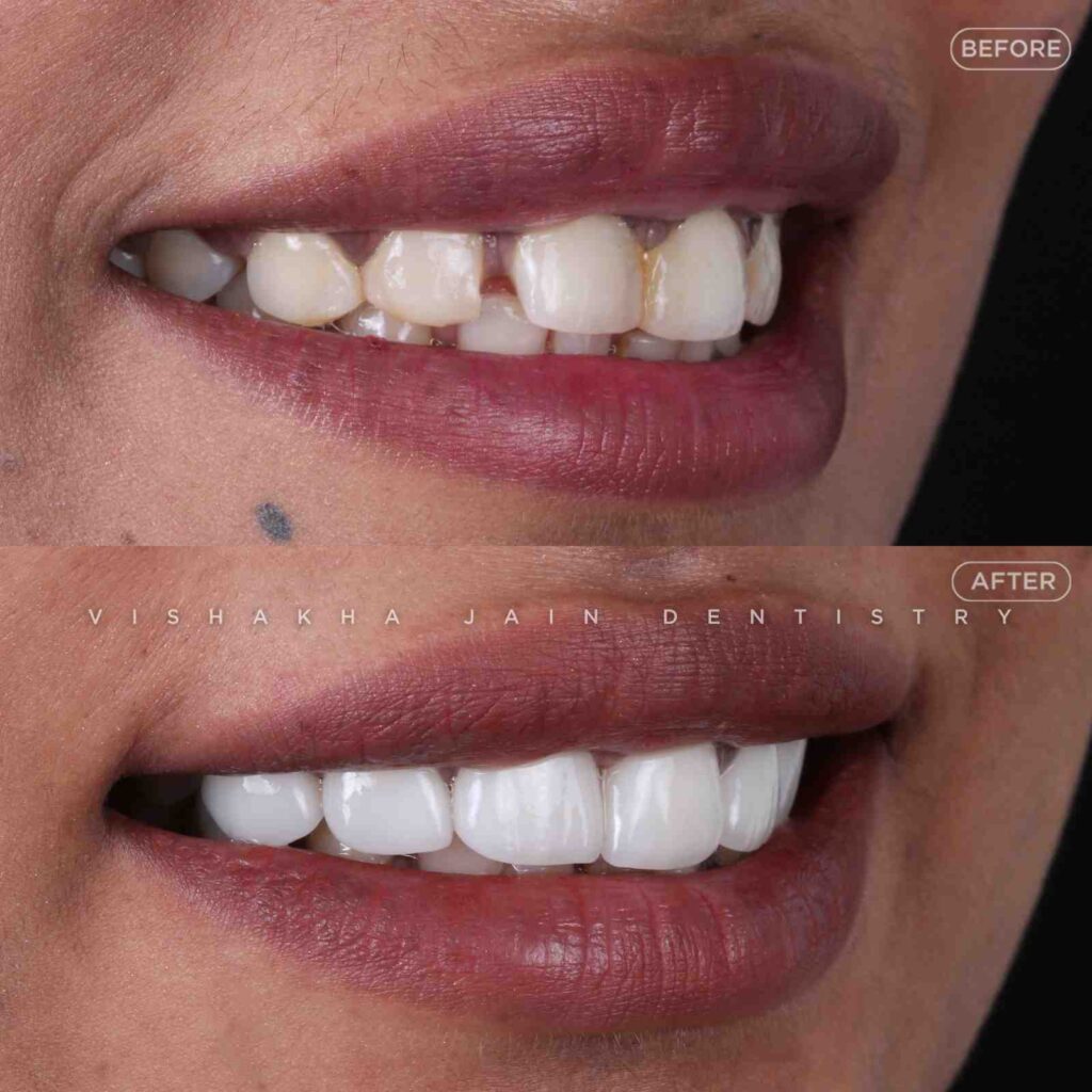 dental venner treatment indore