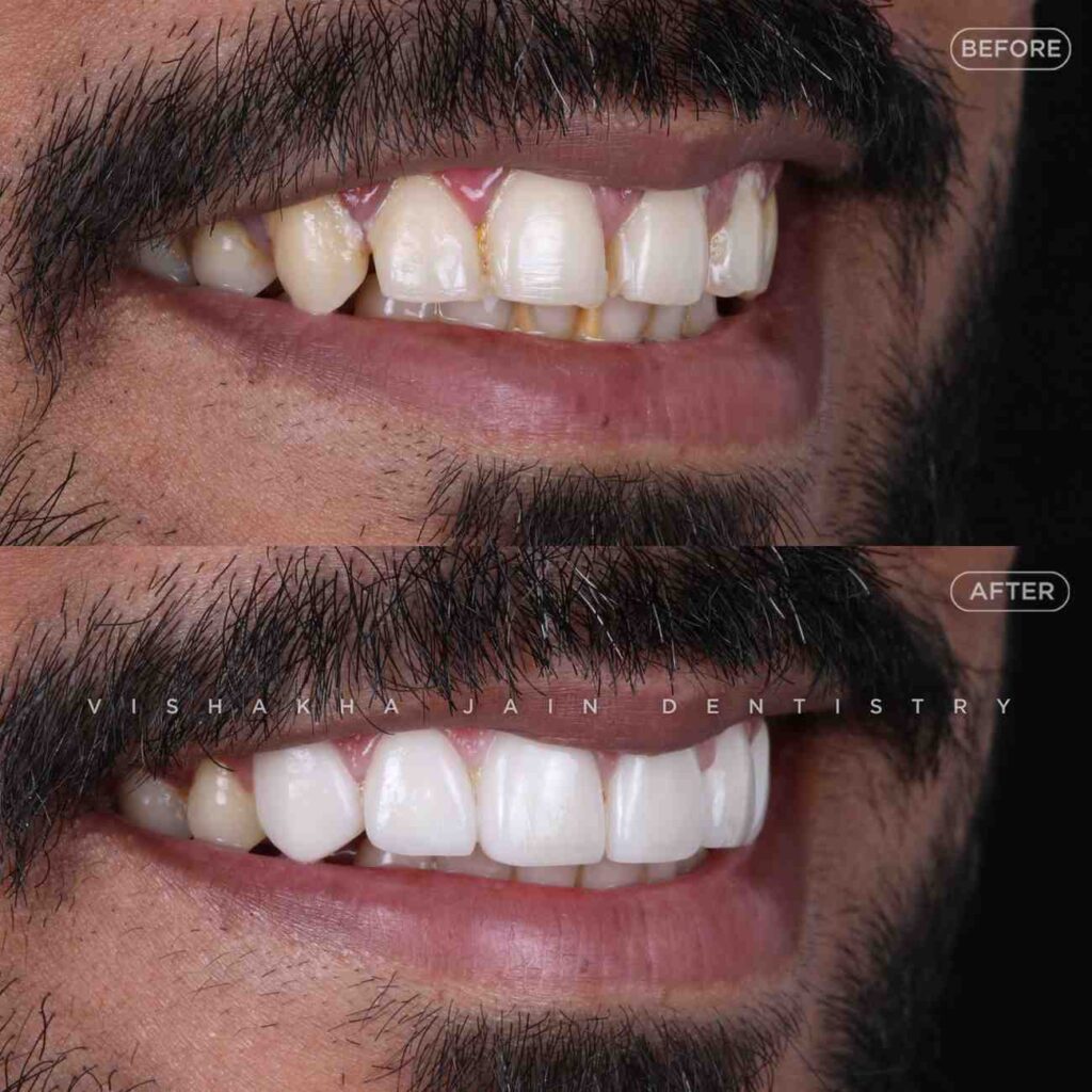 dental whitening treatment