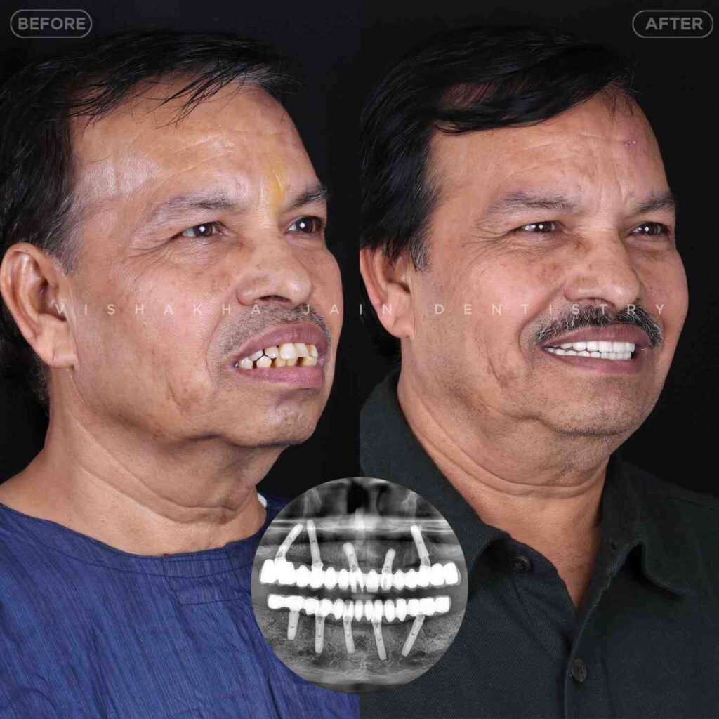 dental full mouth treatment indore