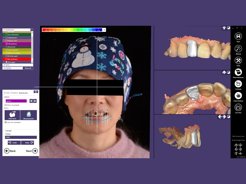 digital implant design treatment indore