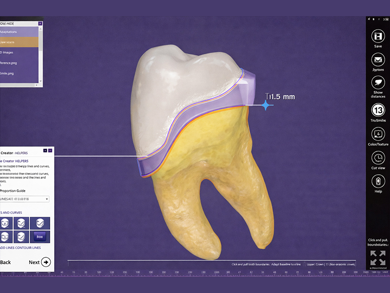 digital working in dental crown