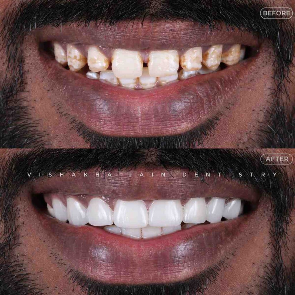 front-teeth-gap-treatment