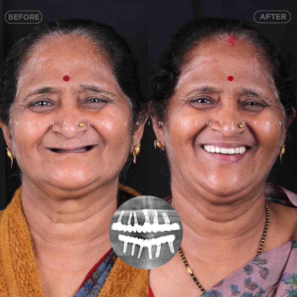 dental full mouth implant indore