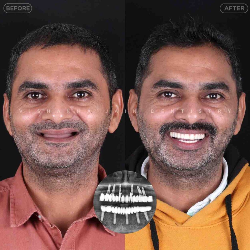 full mouth implant treatment indore