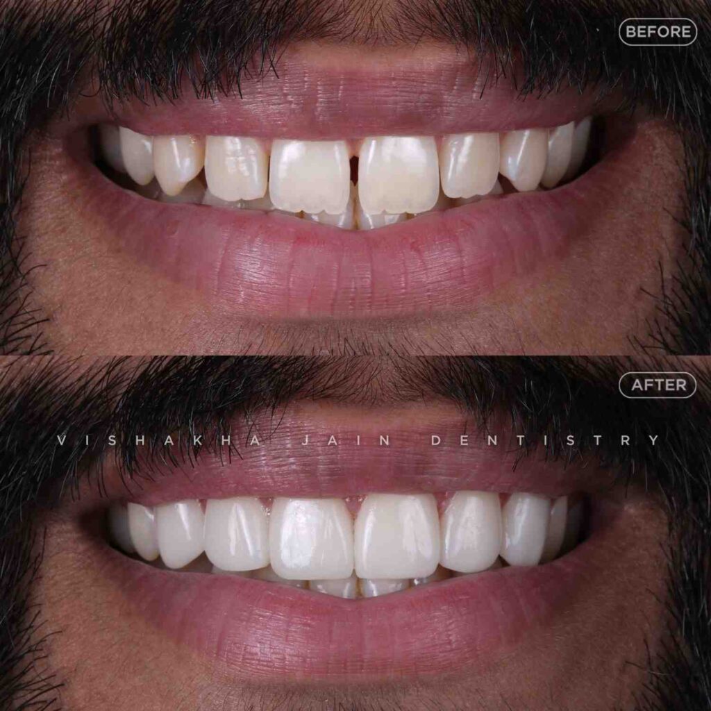 gap-closing-braces-indore