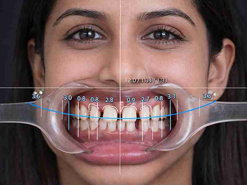 gap treatment in indore