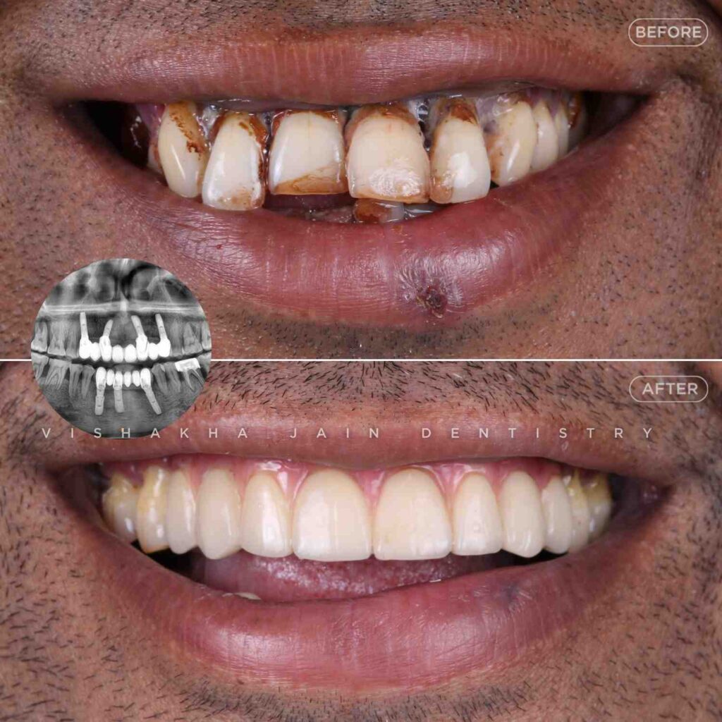 implant-dental-clinic-in-indore