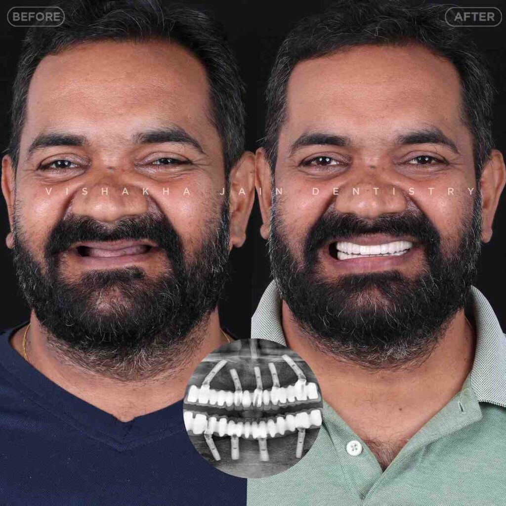 implant full mouth dental treatment indore