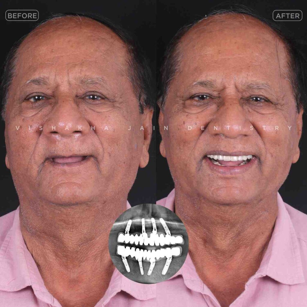 indore full mouth dental implant