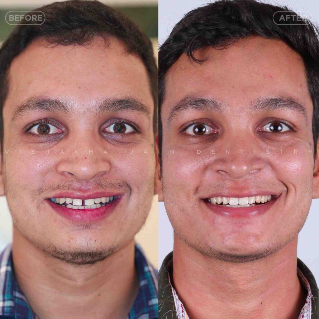 invisibl braces indore