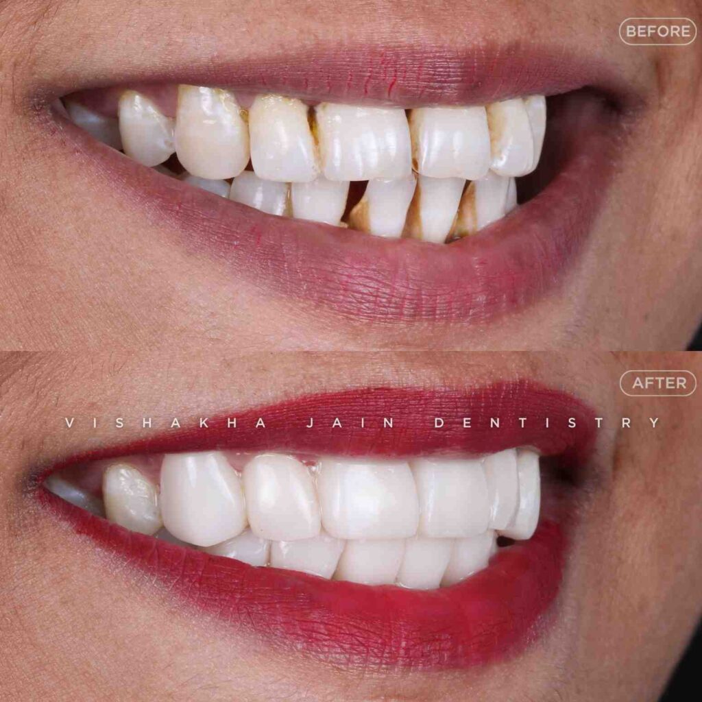 smile-correction-indore