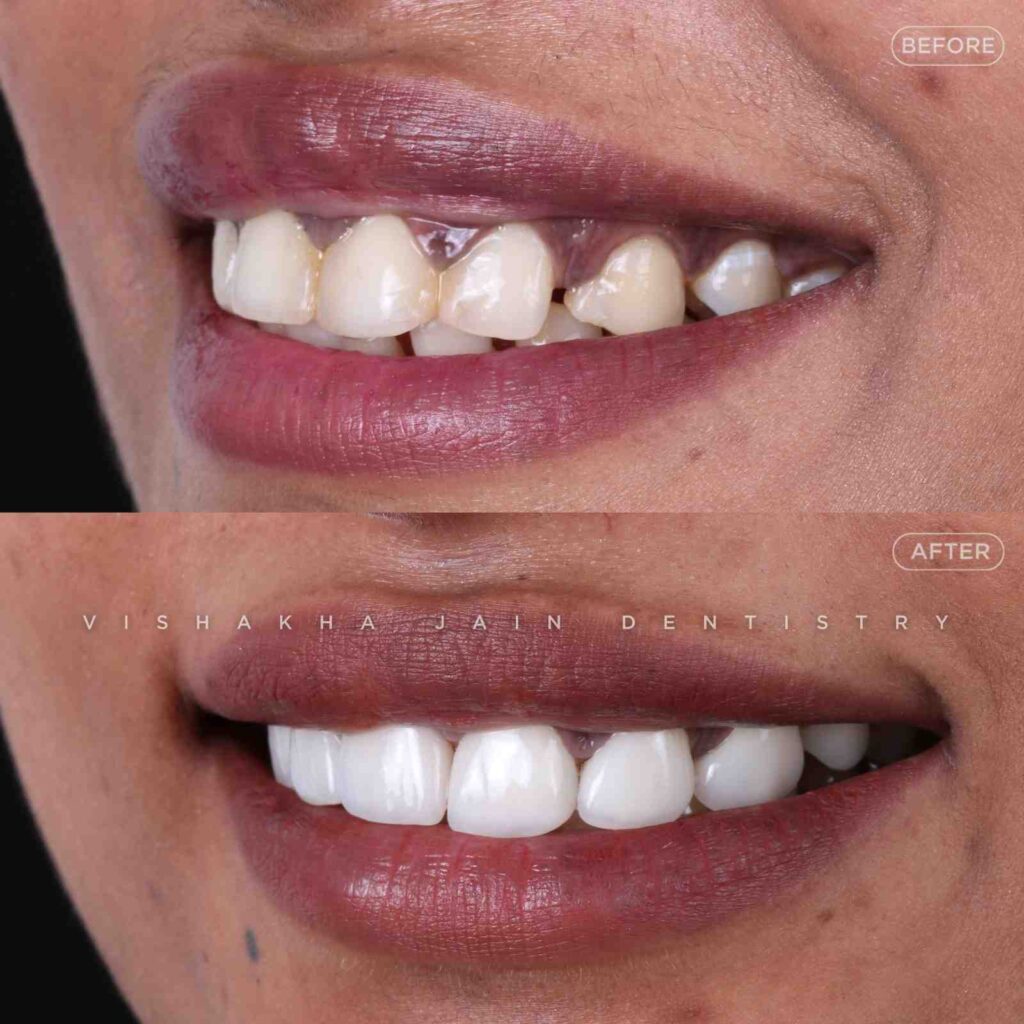 smile-makeover-indore