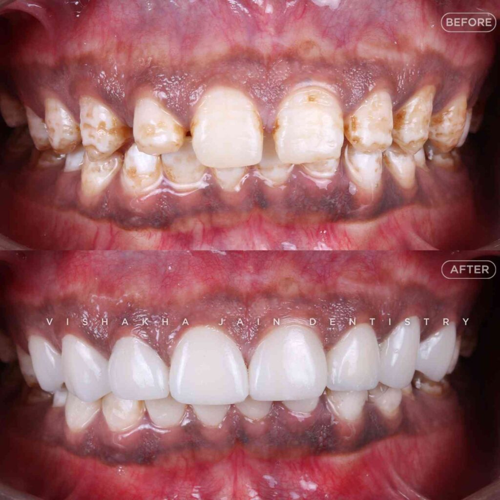 smile makeover indore