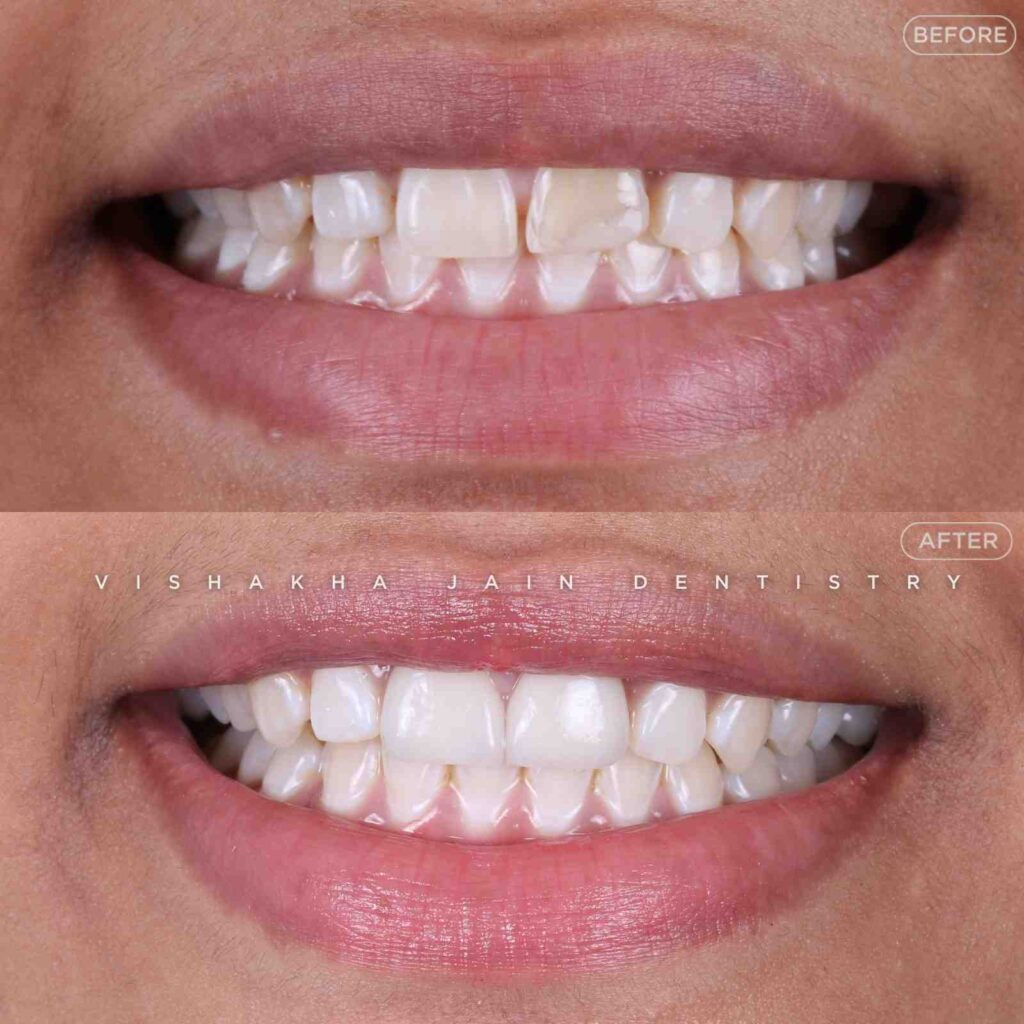 smile makeover indore