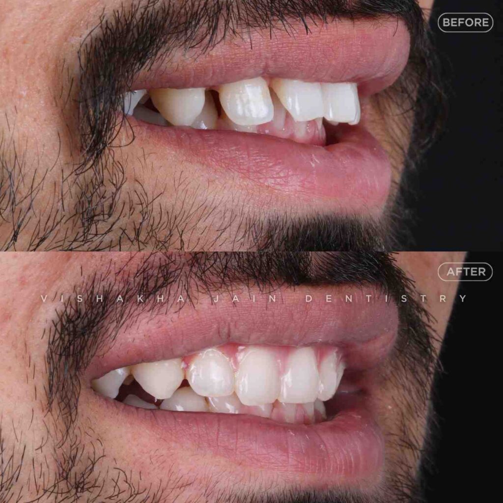 teeth alignment indore