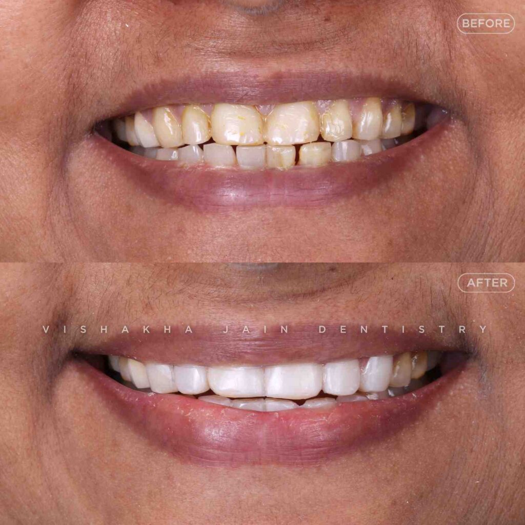 teeth cleaning indore