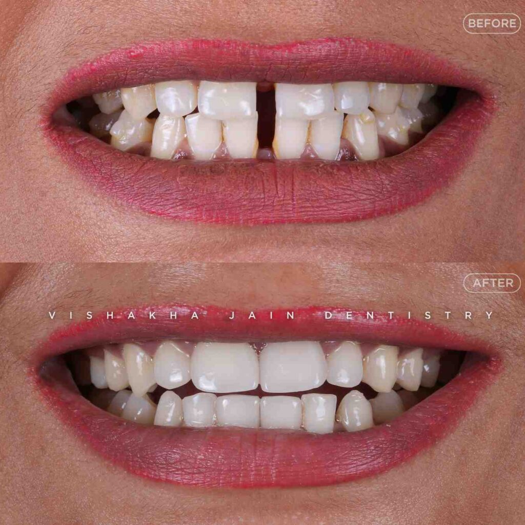 teeth-gap-correction-indore