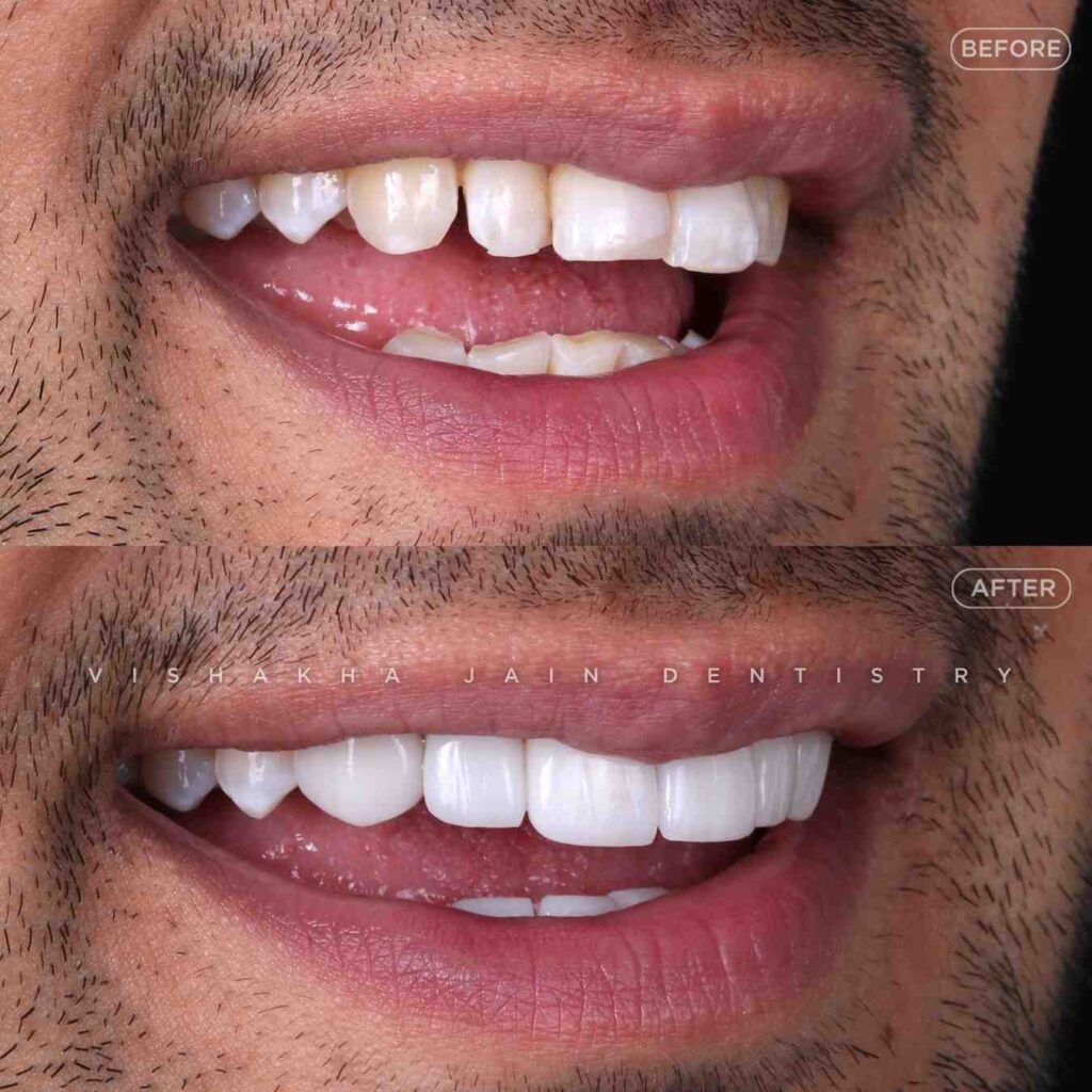 teeth whitening indore