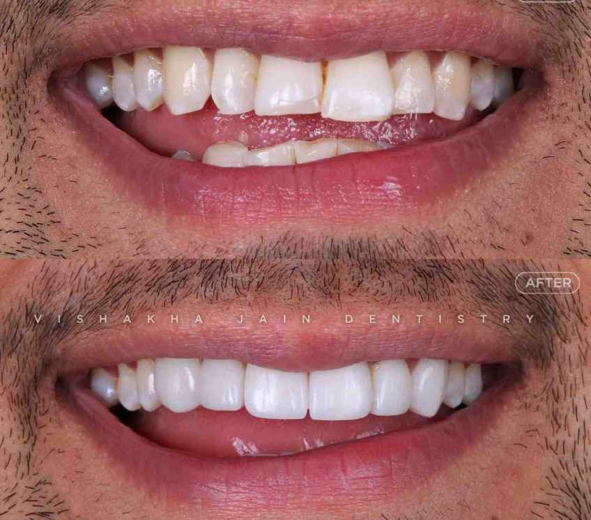teeth whitening treatment indore