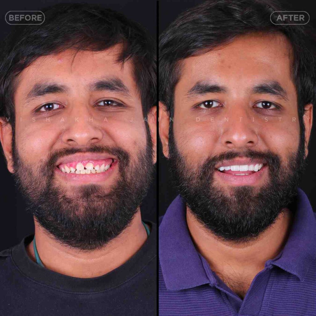 venner treatment in indore